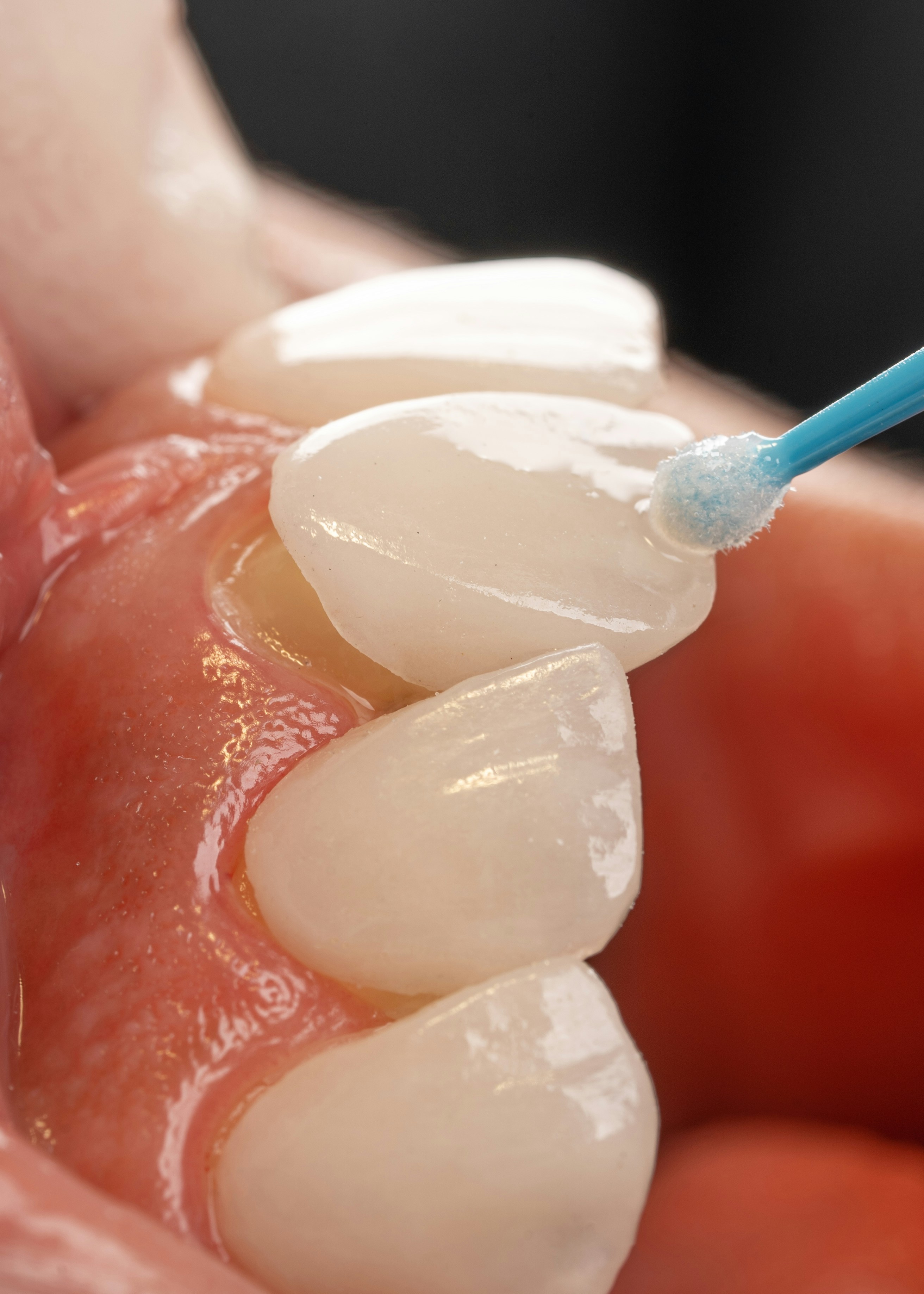 Veneers